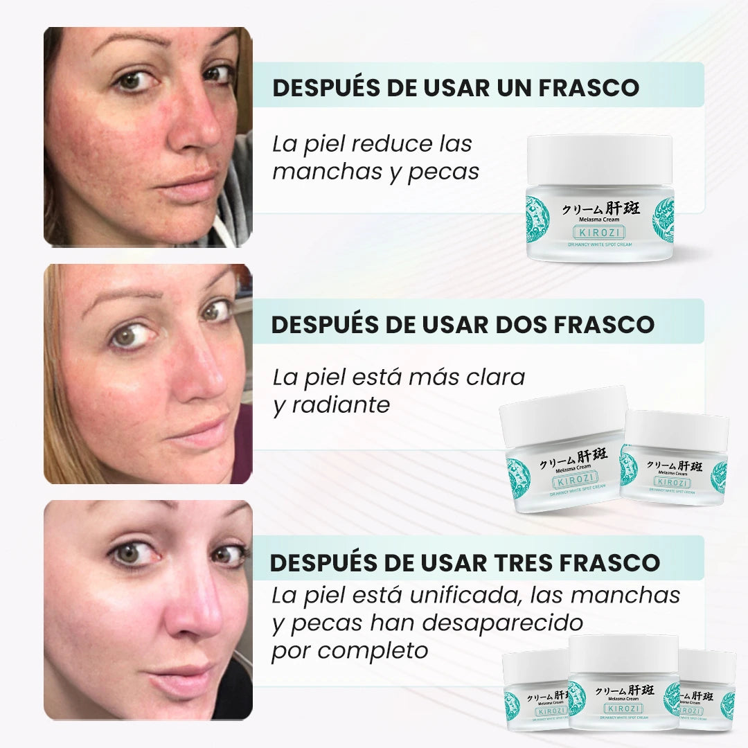 KIROZI™ Crema Anti-Melasma