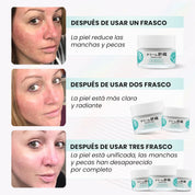 KIROZI™ Crema Anti-Melasma