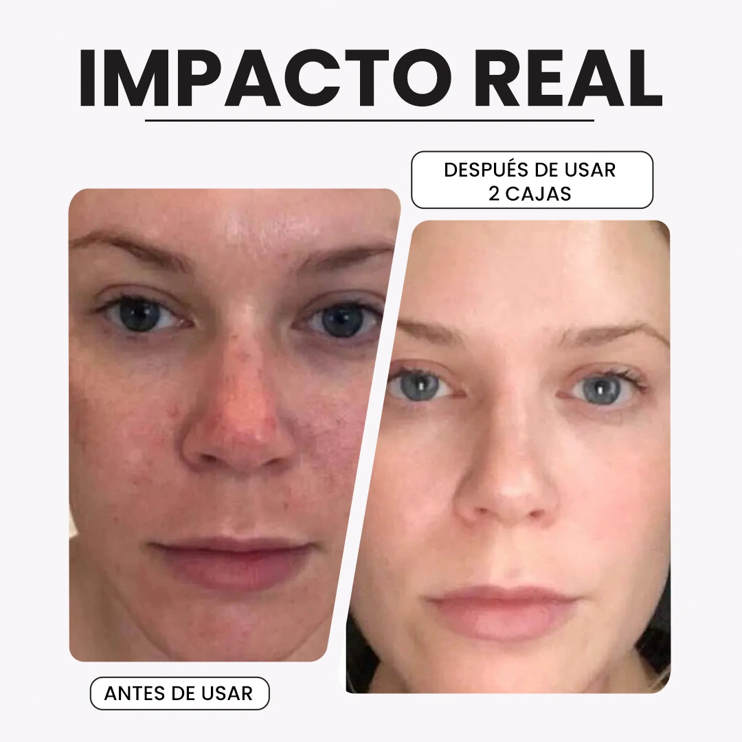 KIROZI™ Crema Anti-Melasma