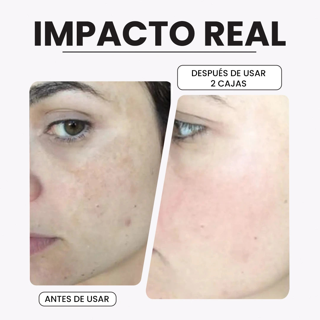 KIROZI™ Crema Anti-Melasma