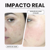 KIROZI™ Crema Anti-Melasma