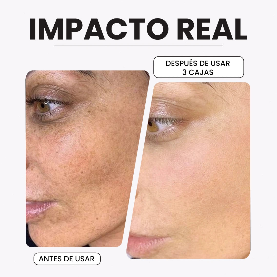 KIROZI™ Crema Anti-Melasma